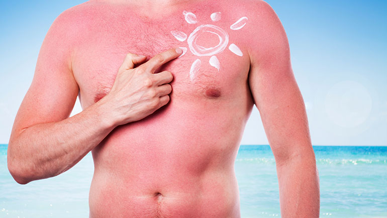 Tips voor een verbrande huid